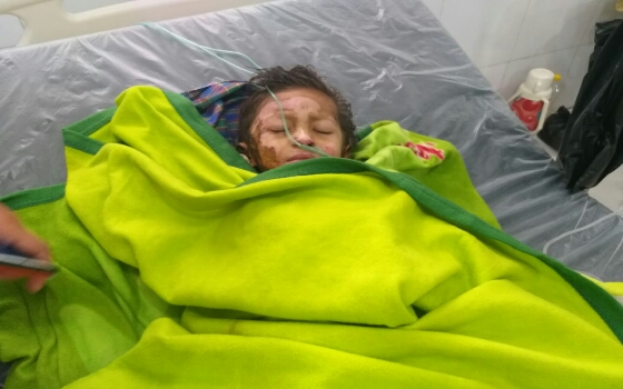Dua Orang Balita Luka Bakar Berat, Butuh Dermawan Untuk Biaya Rumah Sakit